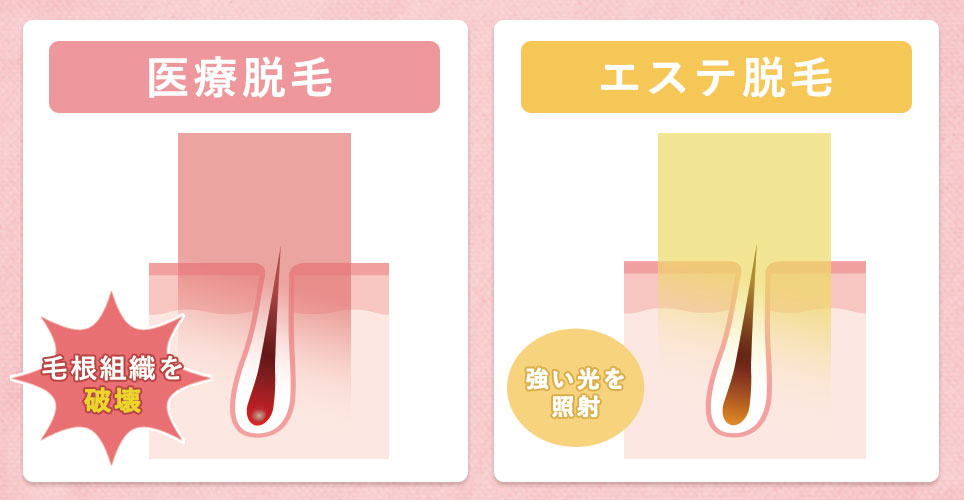 医療とエステの脱毛の違い