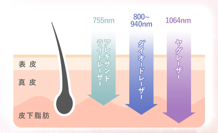 ３種類のレーザーの特徴