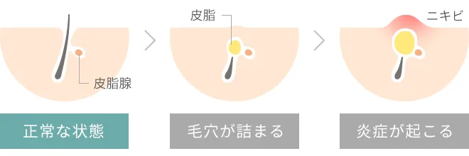 ニキビができる仕組み
