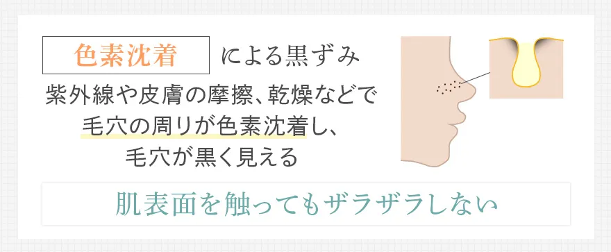 色素沈着によるメラニン毛穴