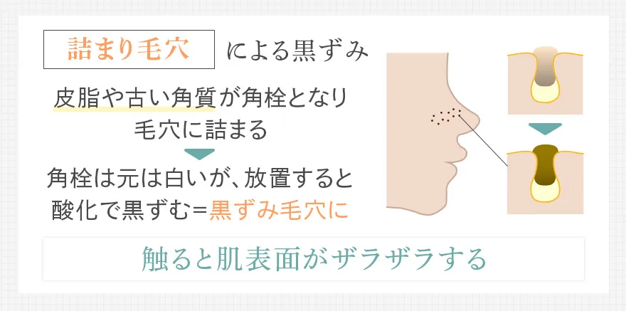 詰まりによる黒ずみ毛穴