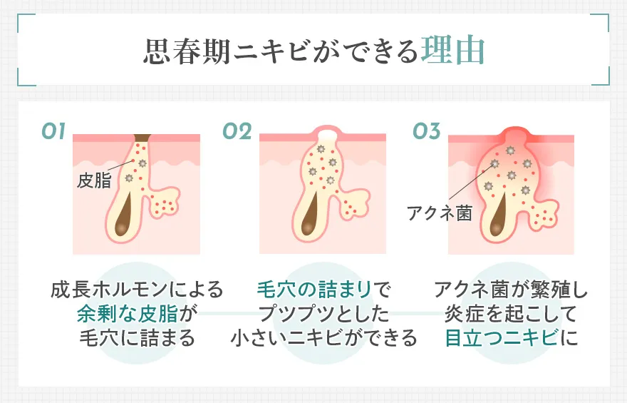 思春期ニキビができる原因