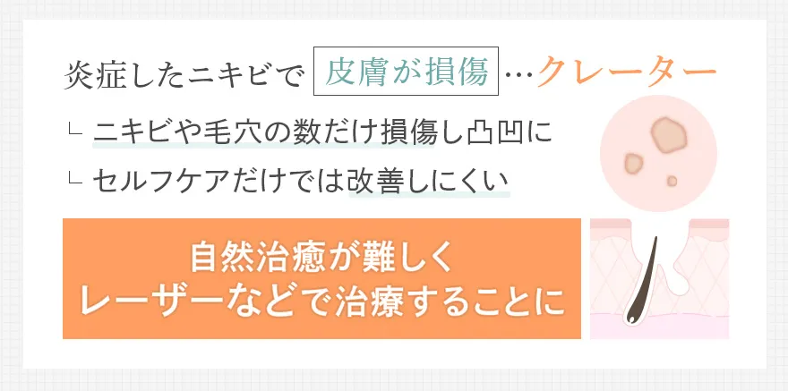 クレーター化したニキビ