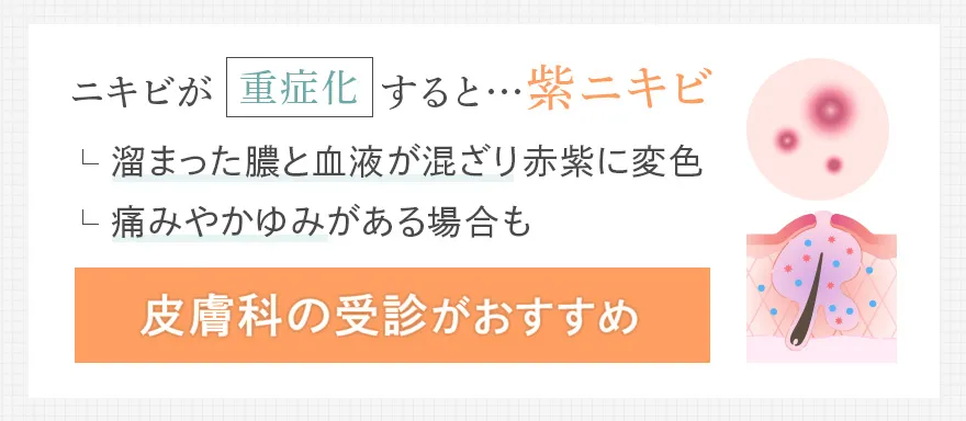 重症化した紫ニキビ